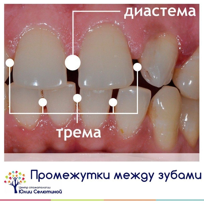 Тремы и диастема: когда это норма? 