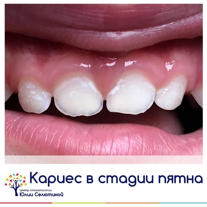 Как начинается кариес у ребёнка?