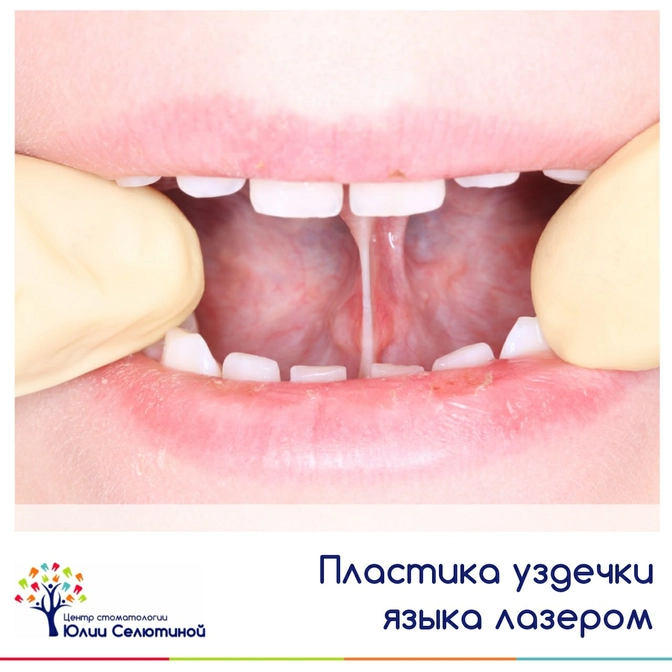 Пластика уздечки языка 