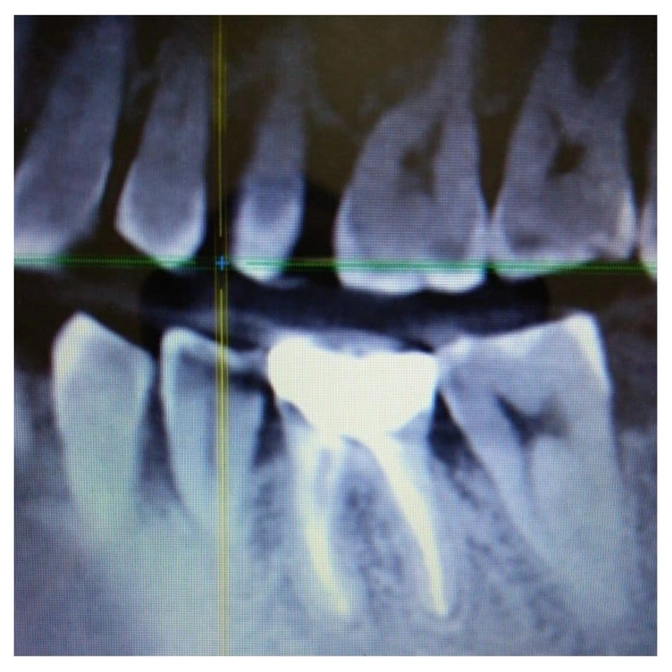 Киста зуба: тактика лечения. 