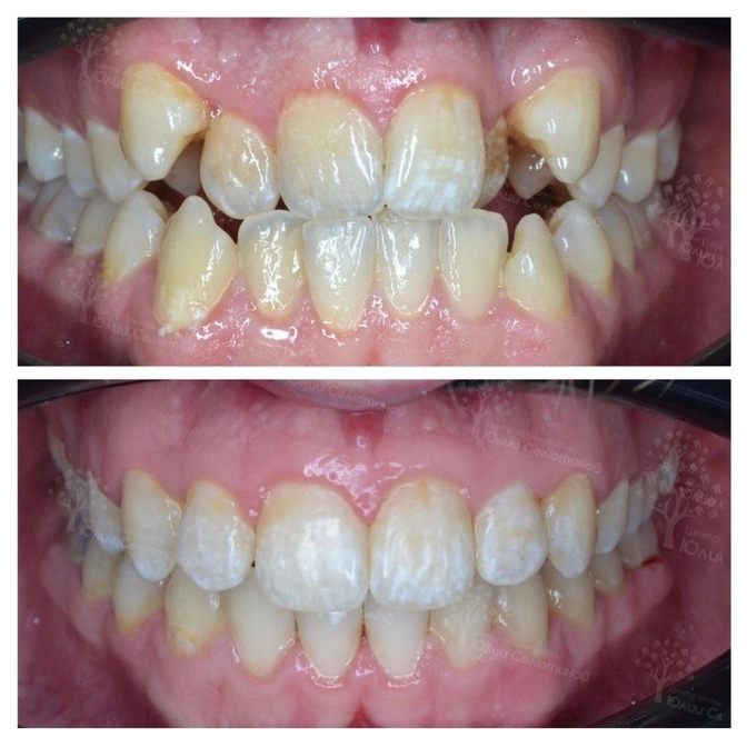 Эстетика после брекет-лечения 