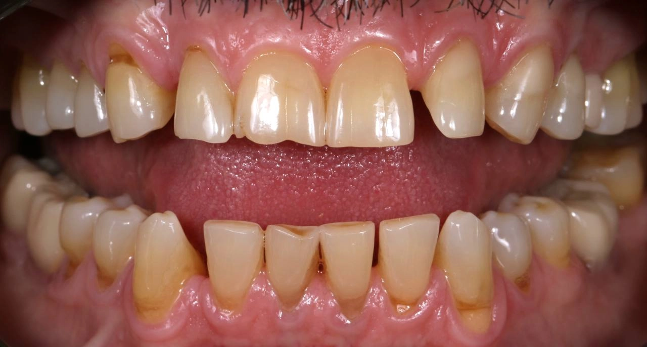 Изображение зубов до прихода в клинику