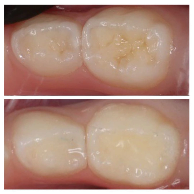 Как не запустить кариес?