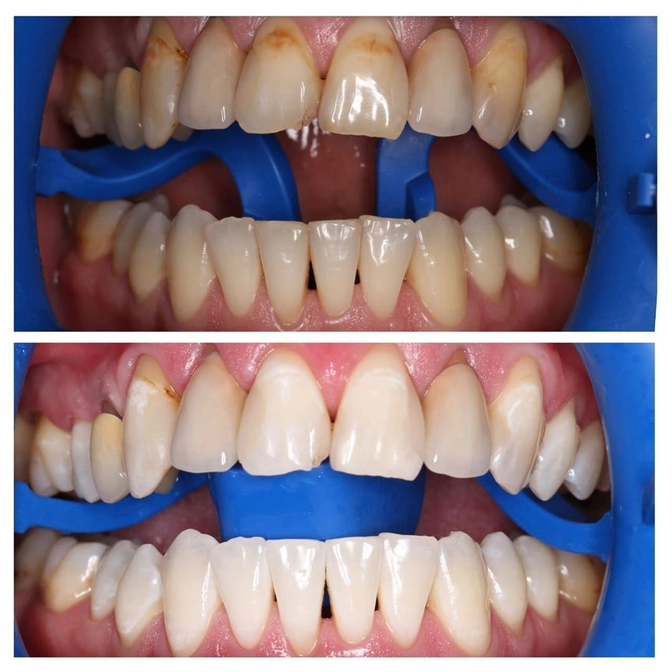 Отбеливание зубов: нюансы.