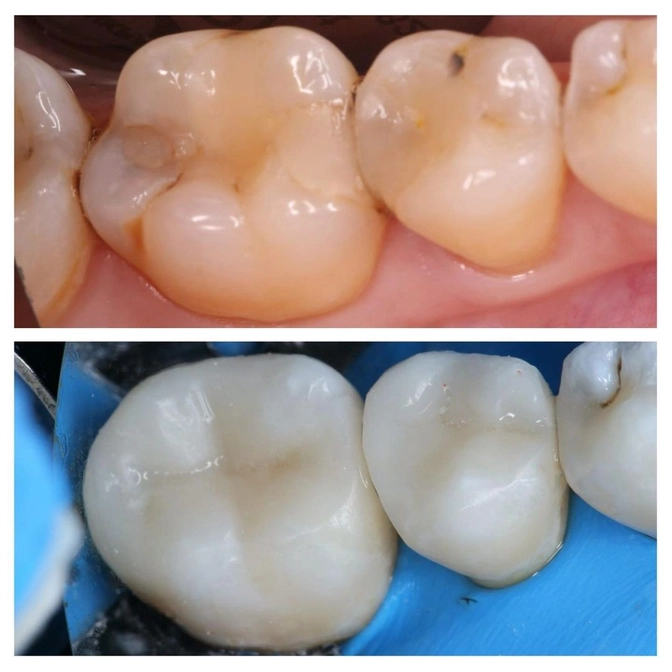 Лечение зубов перед брекетами 