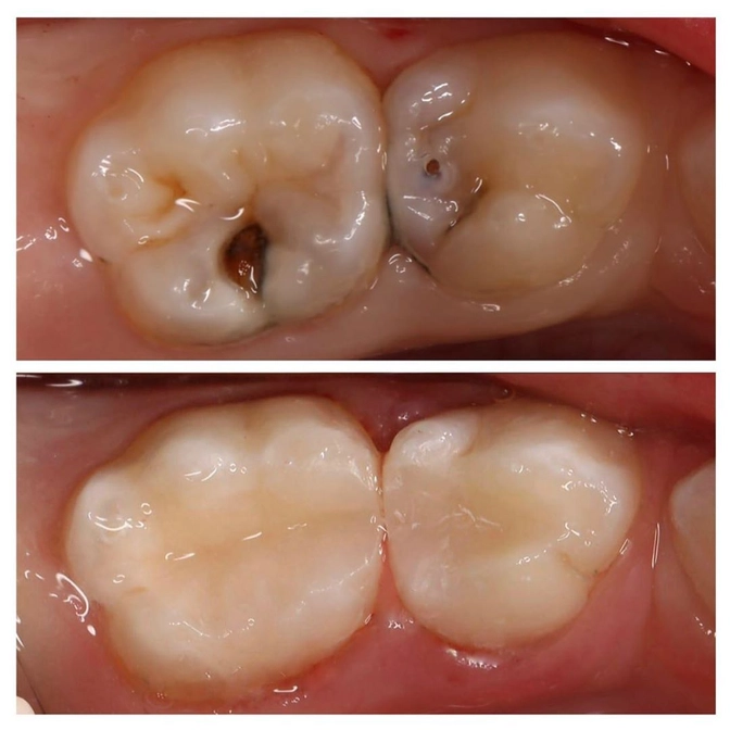 Сложный случай: как мы лечили зубы у 5-летнего малыша.