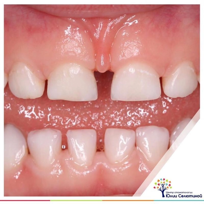 Диастема в молочном прикусе: норма ли это? что делать?