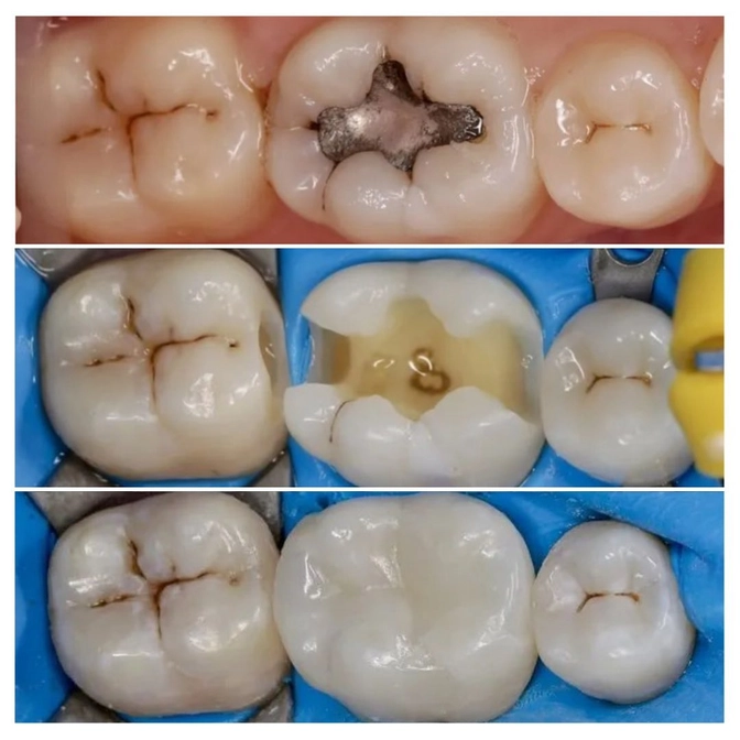 Амальгама. Минусы технологии. 