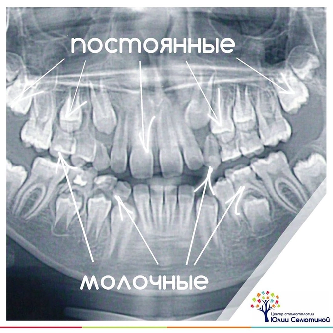 Виды прикуса: сменный прикус.
