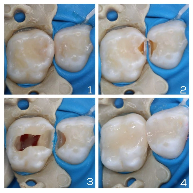 Пример запущенного скрытого кариеса 