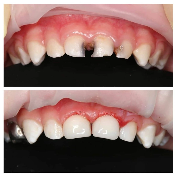 Лечение 2-детки под наркозом 