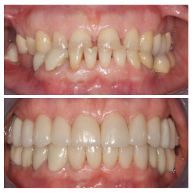 Зачем лечить бруксизм?