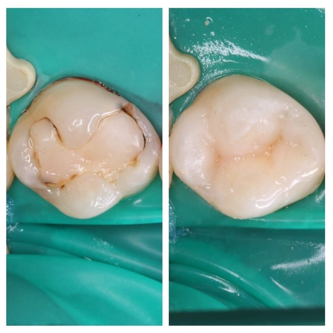 Лечение кариеса постоянного зуба 