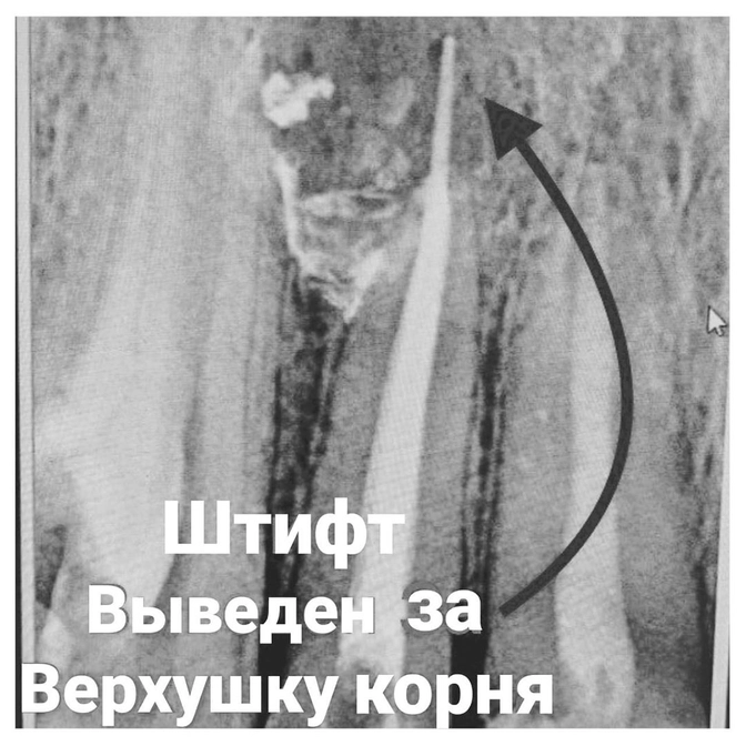 Лечение кисты зуба. 