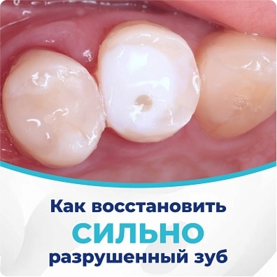 Восстановление зуба техникой build-up