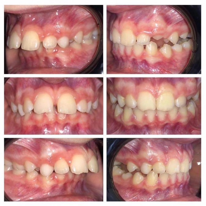Лечение на аппарате Твин-блок