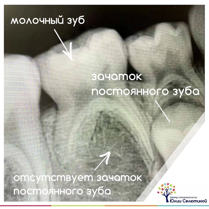 Почему молочный зуб выпал, а постоянный не прорезался? 