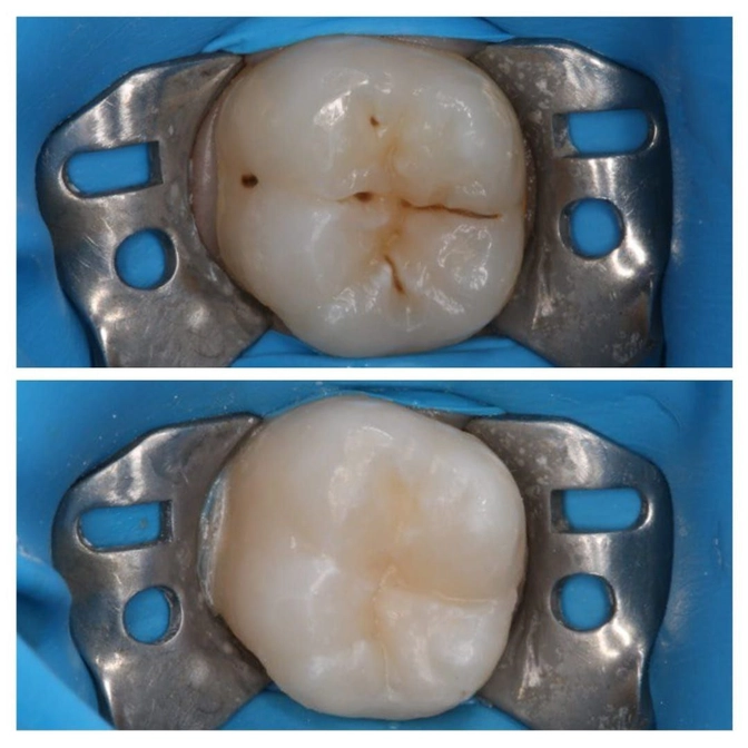 Лечение кариеса у 6-летки 