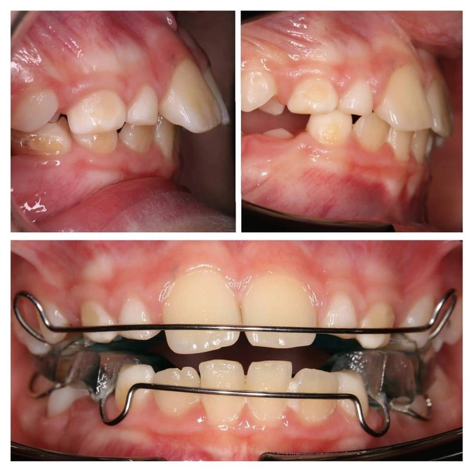 Аппарат Твин-Блок: клинический случай. 