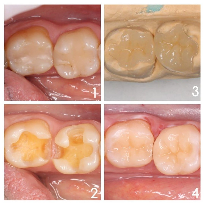 Керамическая вкладка - альтернатива пломбы. 