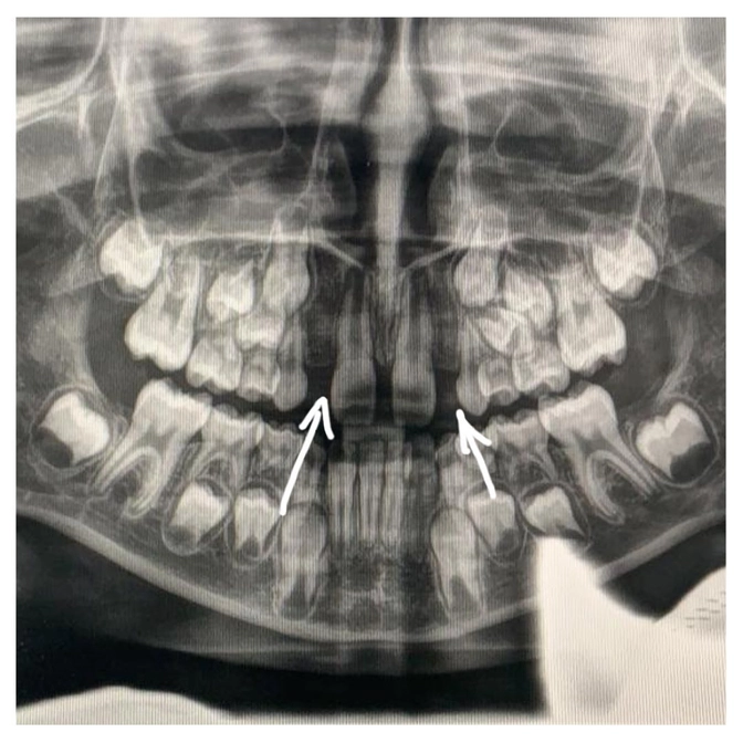 Молочный зуб выпал, а постоянного нет: что делать?
