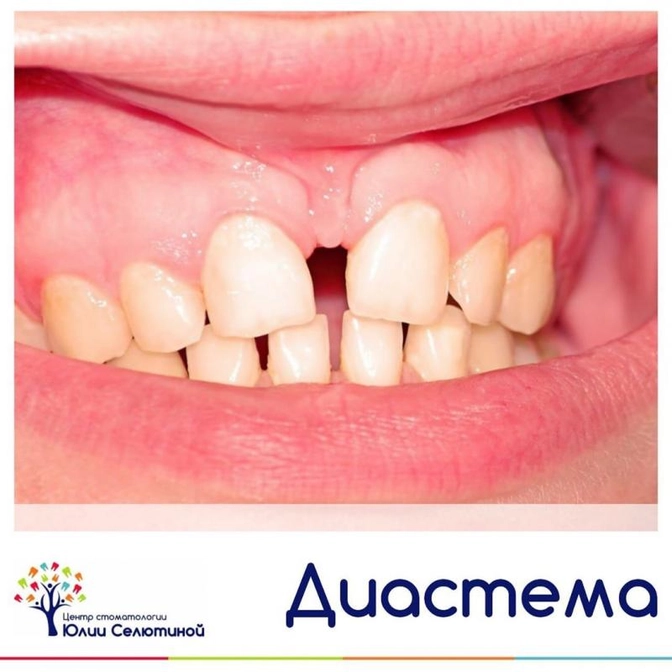 Что такое диастема?
