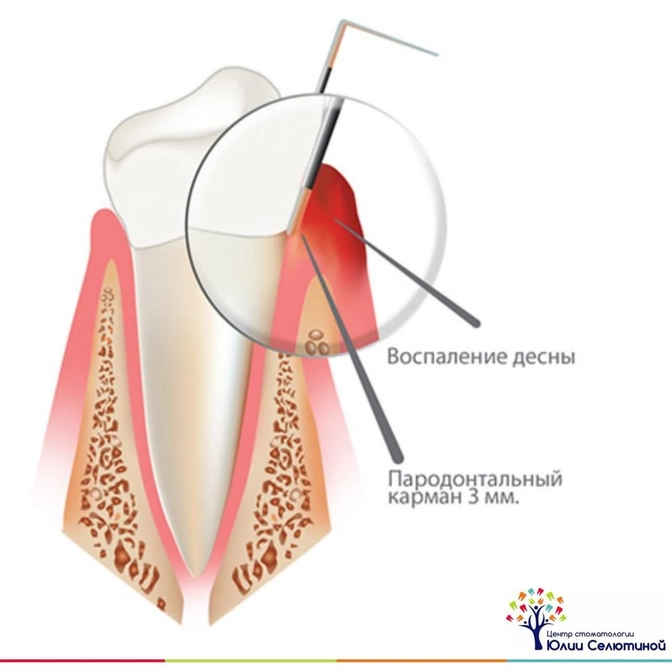 Парадонтальный карман: причины, лечение, профилактика.