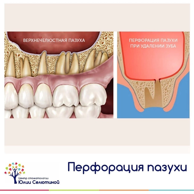 Осложнения: перфорация верхнечелюстной пазухи.