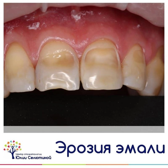 Эрозия эмали зубов: что её вызывает и как лечим?
