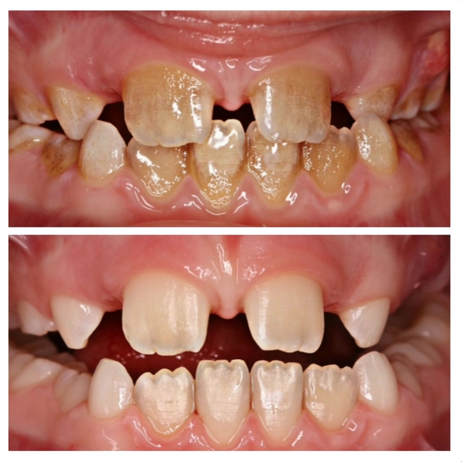 О регулярности проф гигиены 