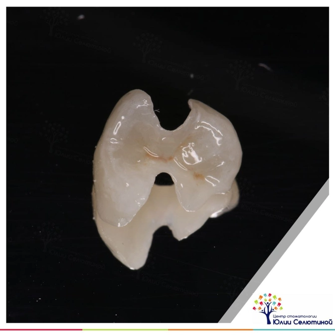 Менять нужно не только старые пломбы, но и старые керамические накладки.